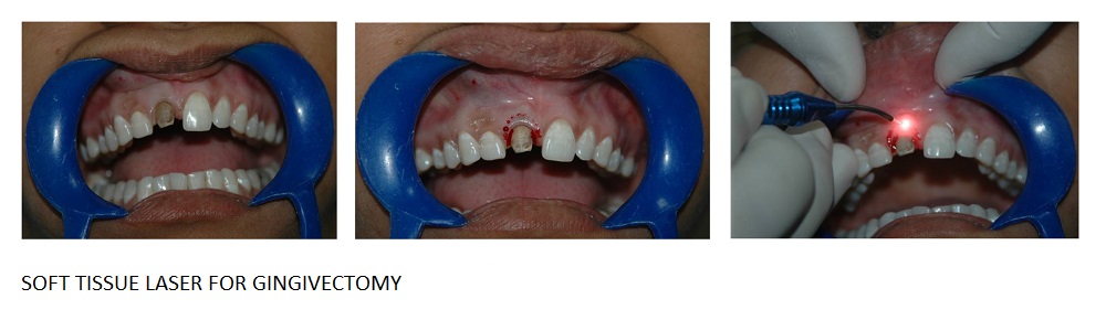 Dental implants in panchkula