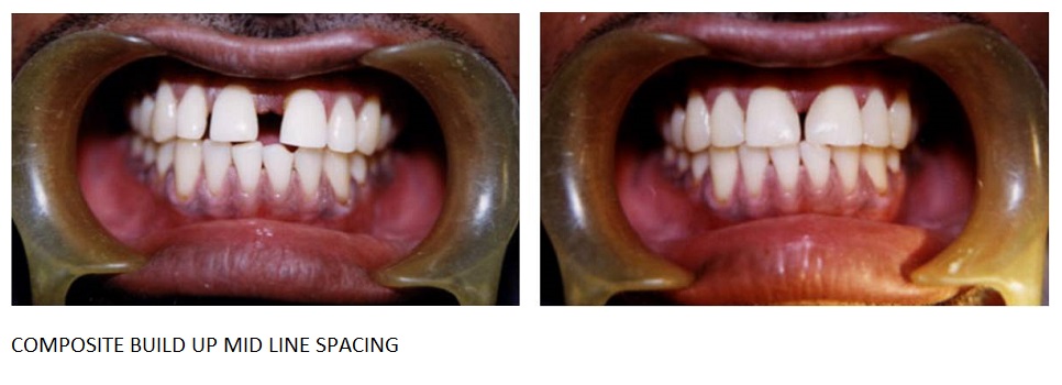 Teeth whitening in Panchkula