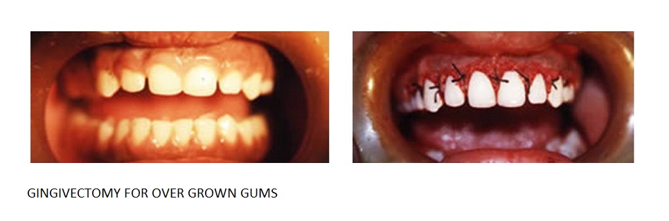 cheap dental implants in Panchkula