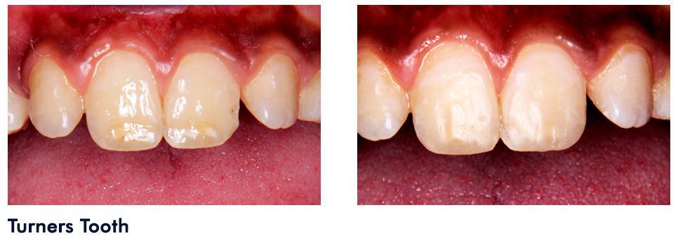 Teeth whitening in Panchkula