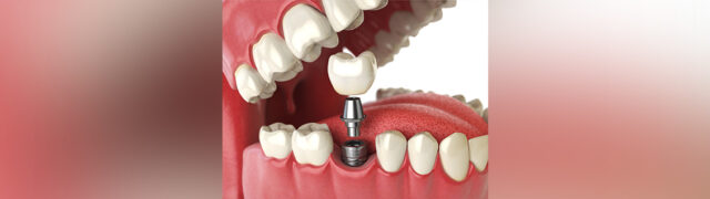 Dental implants in panchkula