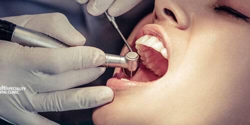 Dental Implants in Chandigarh