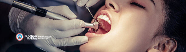 Dental Implants in Chandigarh