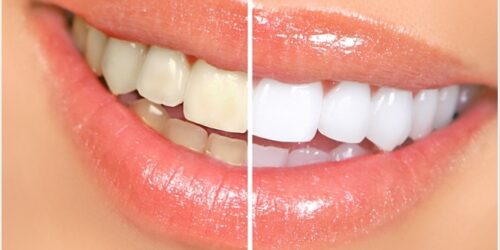 Teeth Whitening: