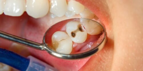 most common dental disease in children