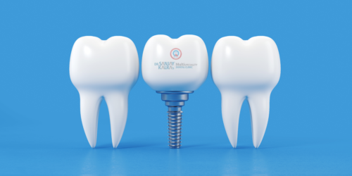 best dental implant in Chandigarh