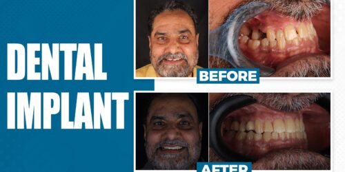 Col. Man Mohan Regained His Smile at 65 by sanjay kalra dental clinic