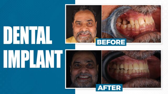 Col. Man Mohan Regained His Smile at 65 by sanjay kalra dental clinic