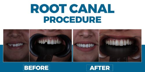 Root Canal Procedure