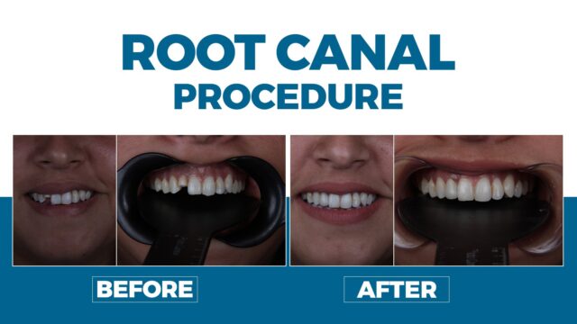 Root Canal Procedure