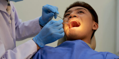 Wisdom tooth extraction