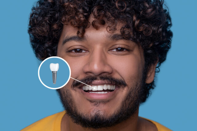 Dental Implants Cost in India