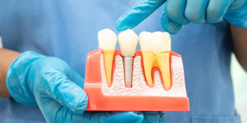 Cost of root canal treatment in india