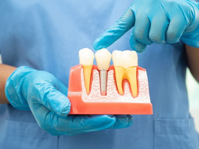 Cost of root canal treatment in india