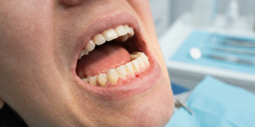 Warning signs of poor oral hygiene routine