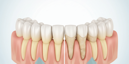 Effects of acid reflux on teeth showing enamel erosion and tooth surface damage