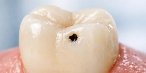 Early stage cavity showing a small hole in the tooth surface