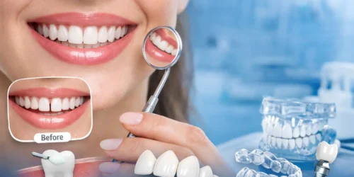 Cosmetic dentistry treatment for permanent teeth gap filling in Panchkula showing natural smile correction with bonding, veneers and aligners